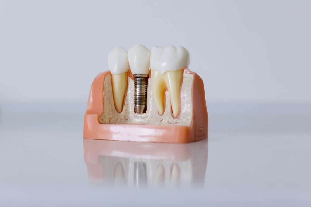 picxostock-dental-implant-9964787_1920.jpg